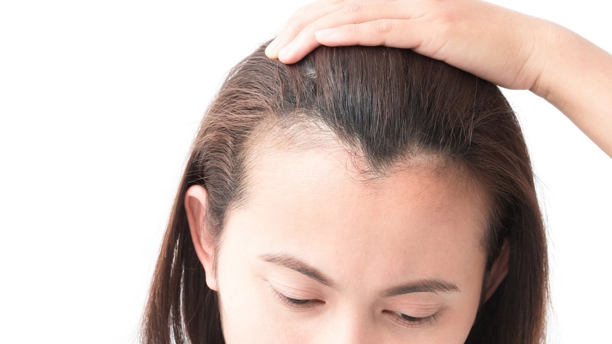 What Black Women Need to Know About Hair Loss - The New York Times